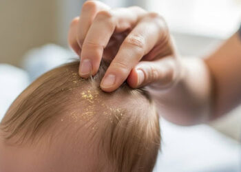 3 Shampoos That Effectively Treat and Prevent Cradle Cap